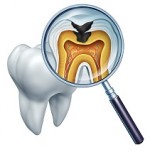 Root Canal